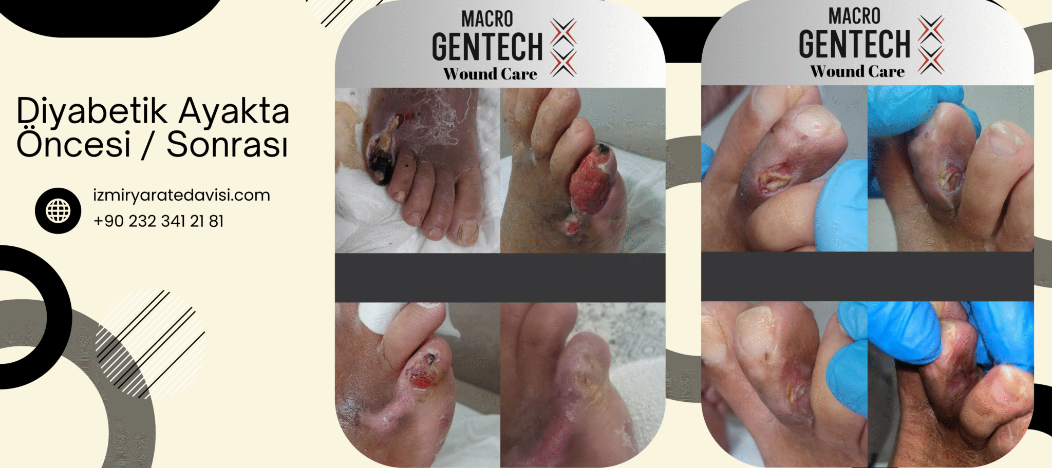 izmir diyabetik ayak yara tedavisi